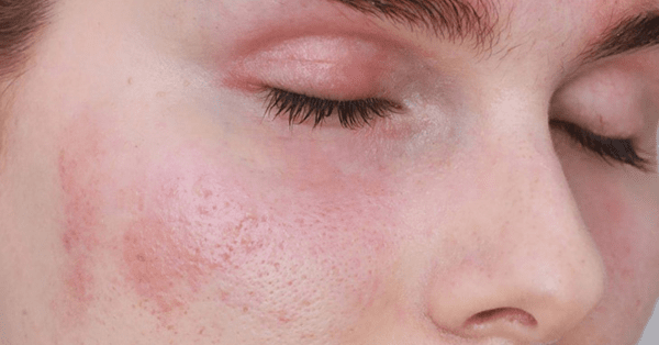 Cách trị dị ứng da mặt