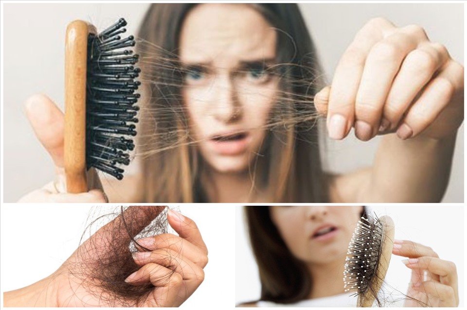 nội tiết tố nữ là nguyên nhân gây rụng tóc