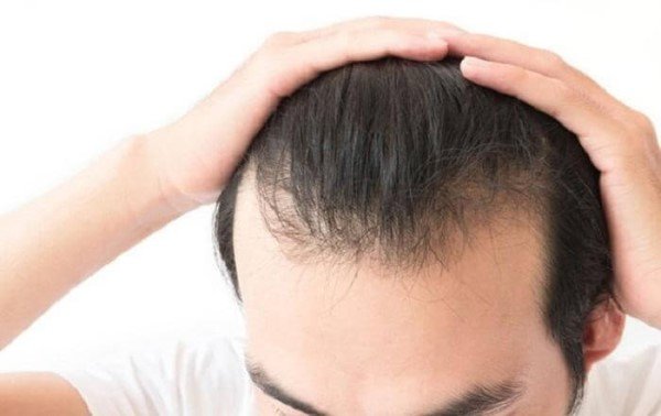 Rụng tóc nhiều ở nam giới là gì?