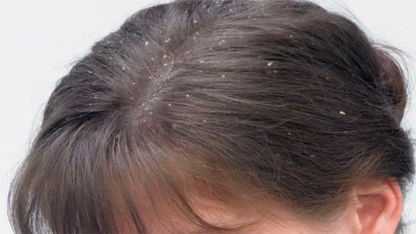 Tình trạng gàu có ảnh hưởng đến sức khỏe của tóc không